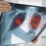 asi-se-diagnostica-el-cancer-de-pulmon-estos-son-los-primeros-sintomas-a-los-que-prestar-atencion.we_.webp