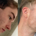 0_47-skin-before-and-after-winter-salePNG.png