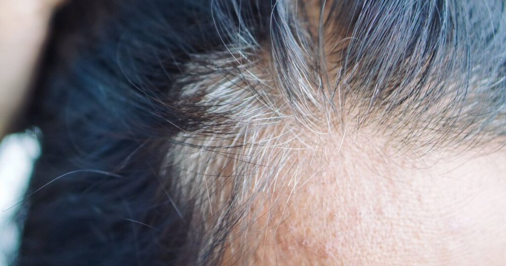 0_Close-up-of-a-Womans-Forehead-and-Hairline-with-Signs-of-Hair-Thinning.jpg