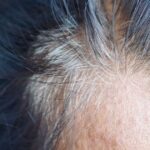 0_Close-up-of-a-Womans-Forehead-and-Hairline-with-Signs-of-Hair-Thinning.jpg