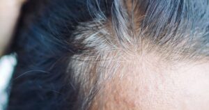 0_Close-up-of-a-Womans-Forehead-and-Hairline-with-Signs-of-Hair-Thinning.jpg