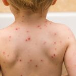 chickenpox-stock.jpeg